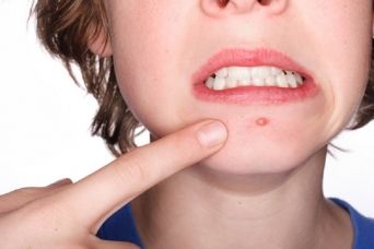 L'acne: dermatosi infiammatoria