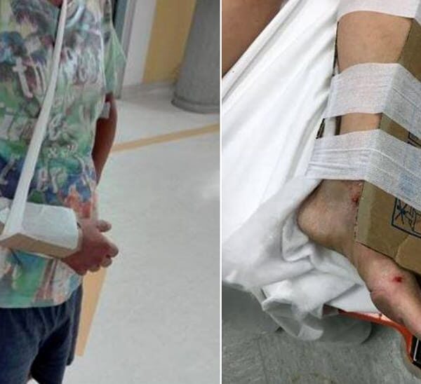 Reggio Calabria: in ospedale manca il gesso