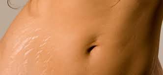 Smagliature: cause e rimedi