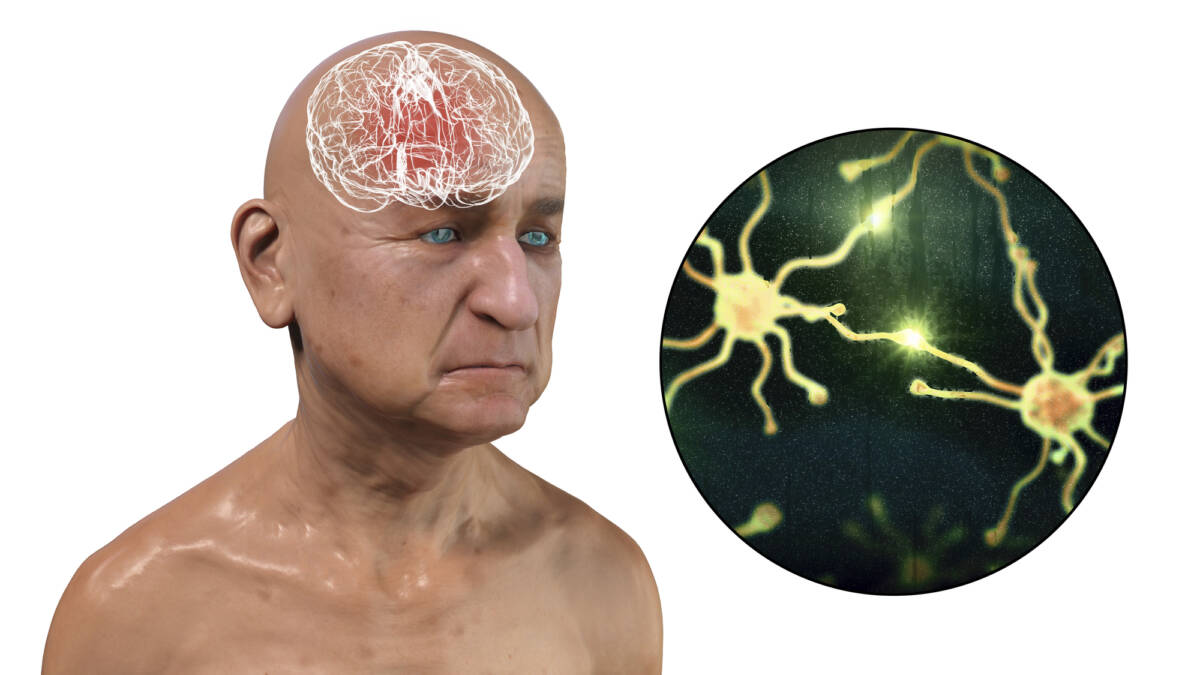 Alzheimer e Parkinson